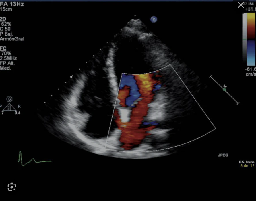 Ecocardiograma Doppler Color